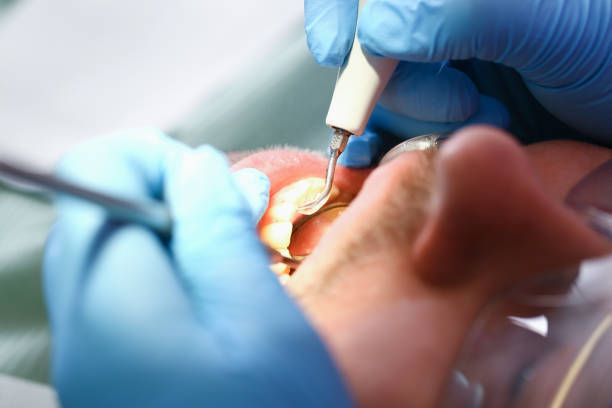 Best Emergency Root Canal Treatment in Fairmount, GA