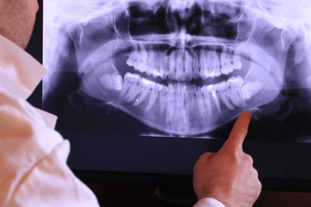 Best Emergency Tooth Extraction in Fairmount, GA